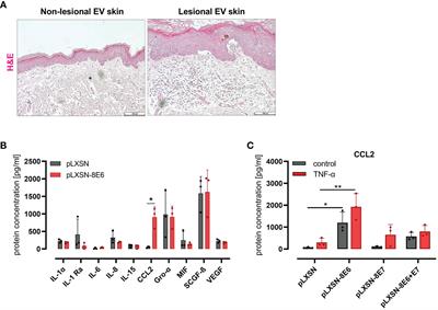 The cutaneous beta human papillomavirus type 8 E6 protein induces CCL2 through the CEBPα/miR-203/p63 pathway to support an inflammatory microenvironment in epidermodysplasia verruciformis skin lesions